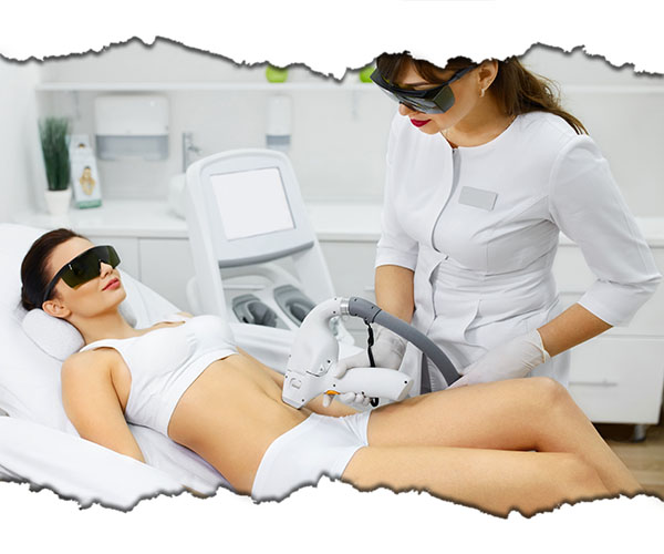 epilare laser