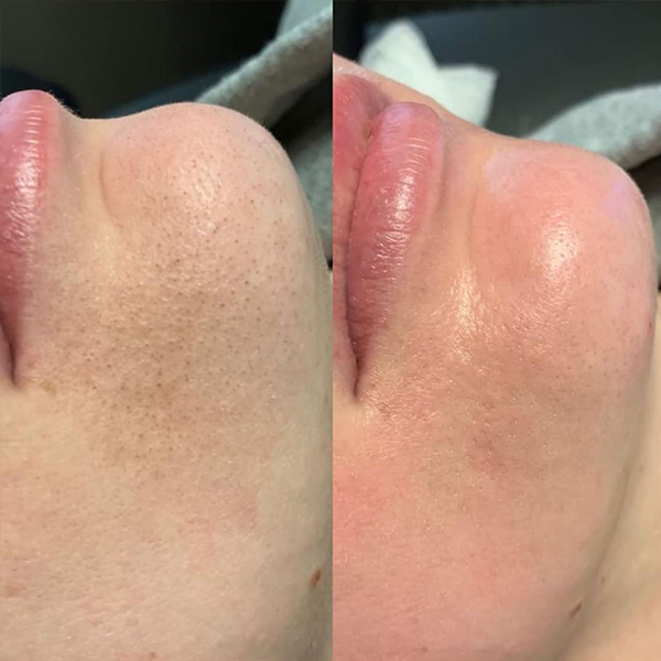 rezultate hidradermabraziune