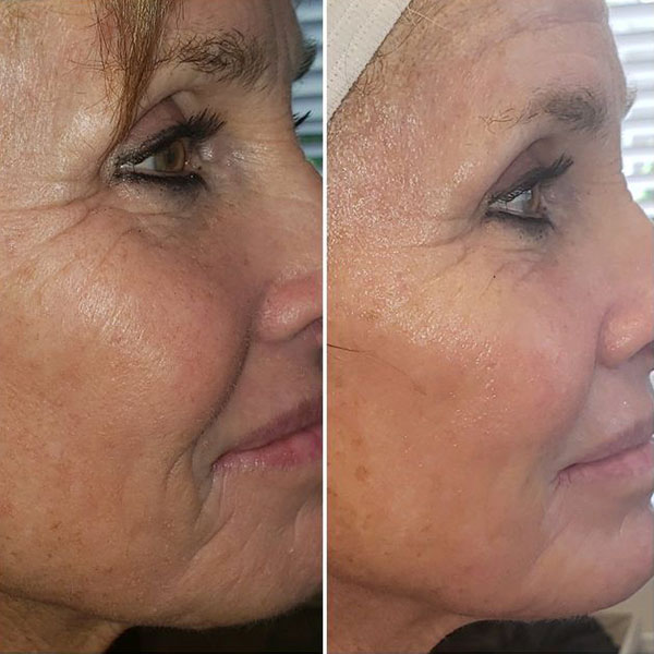 rezultate hidradermabraziune