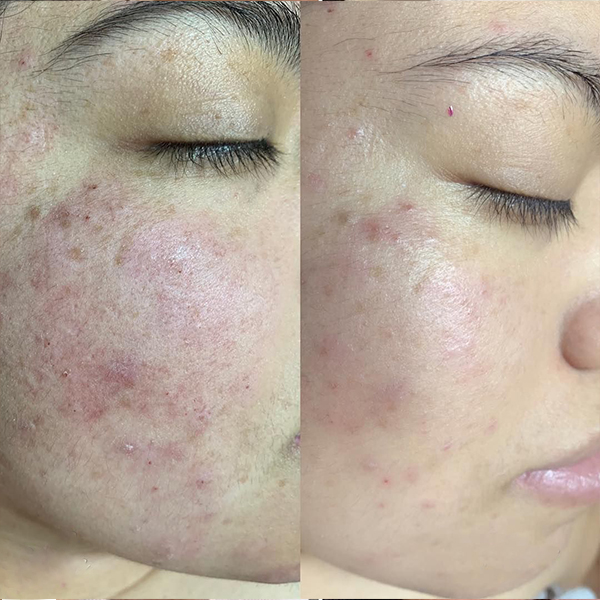 rezultate hidradermabraziune