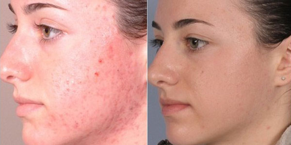 rezultate hidradermabraziune