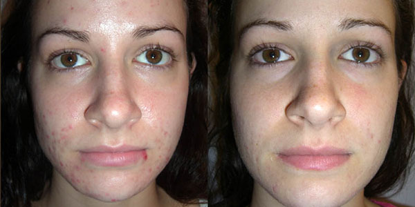 rezultate hidradermabraziune