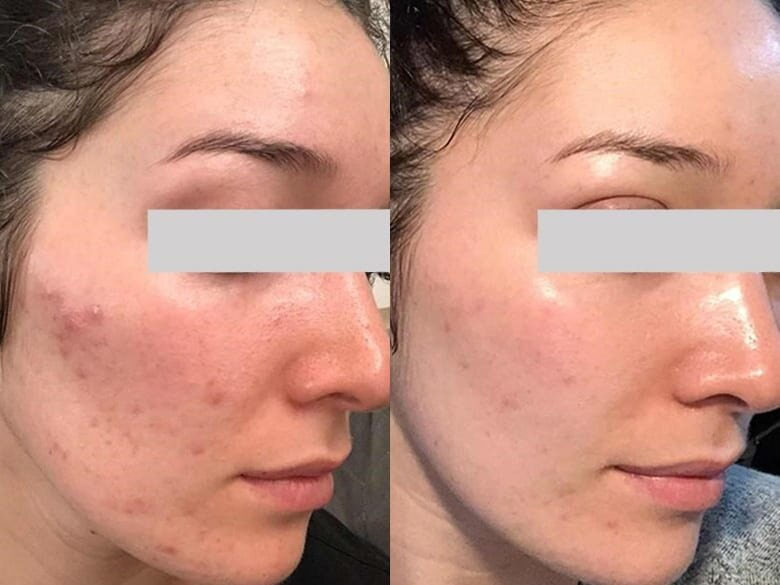 Microneedling elimina cicatricile