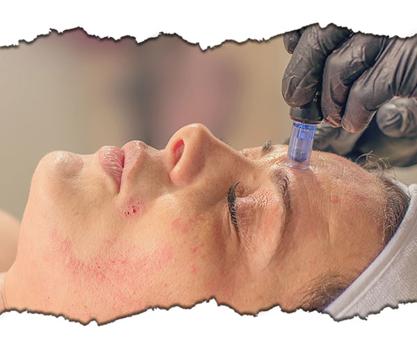 microneedling rejuvenare faciala