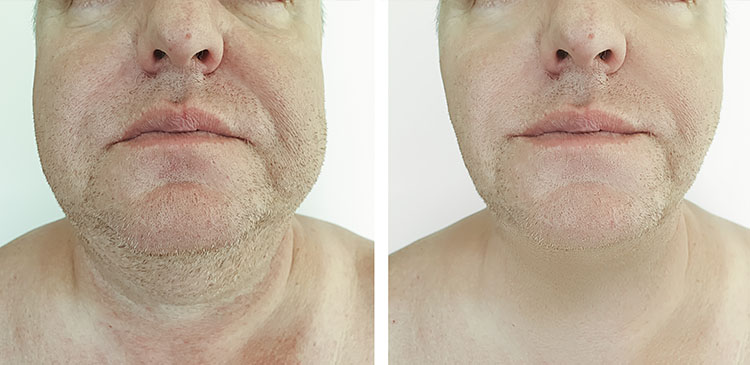 reduce barbia dubla sau gusa