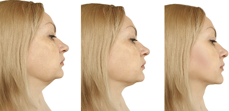 scapşă de barbia dublă sau guşa