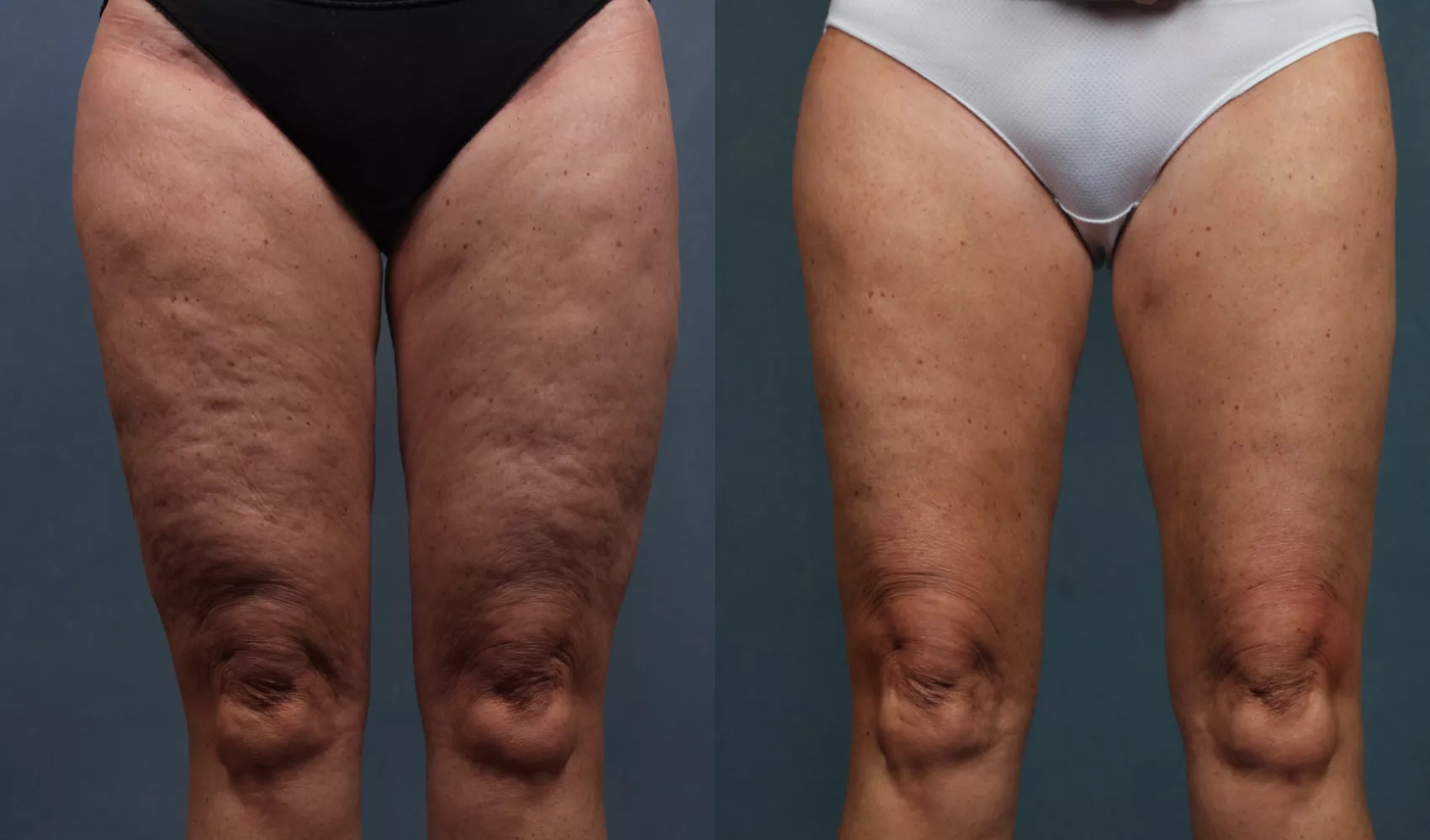 scapă de burtă si de celulită