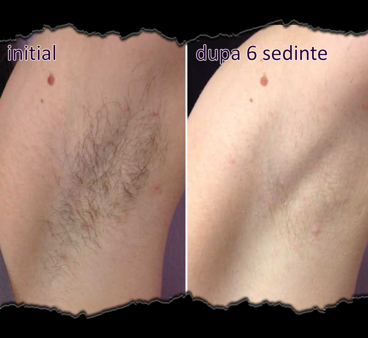 rezultate epilare laser