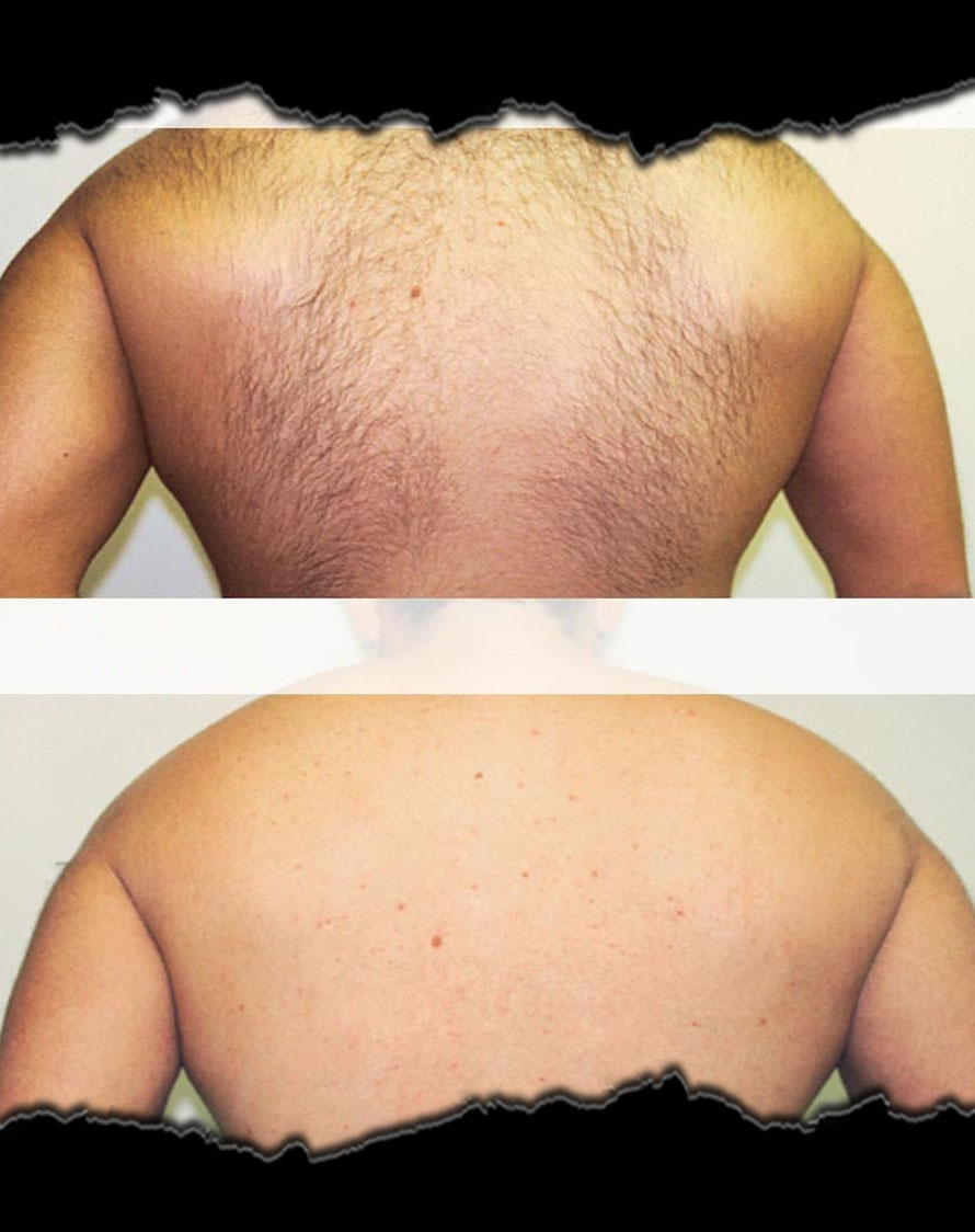 rezultate epilare laser