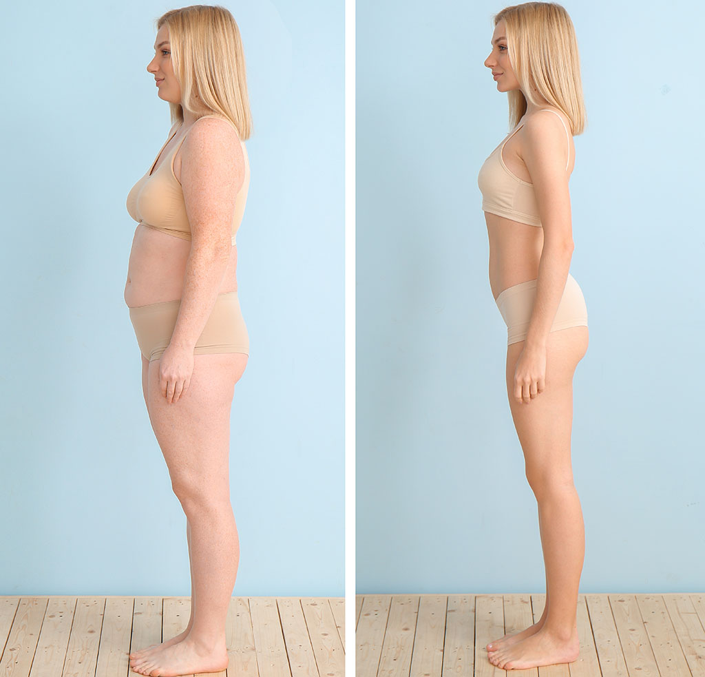 remodelare corporala