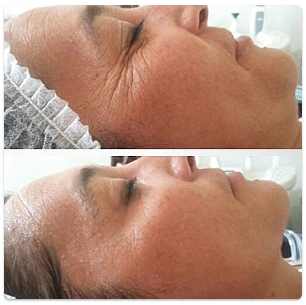 anti-aging facial