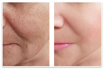 tratament facial anti-rid