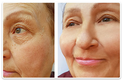 tehnici de eliminare a ridurilor