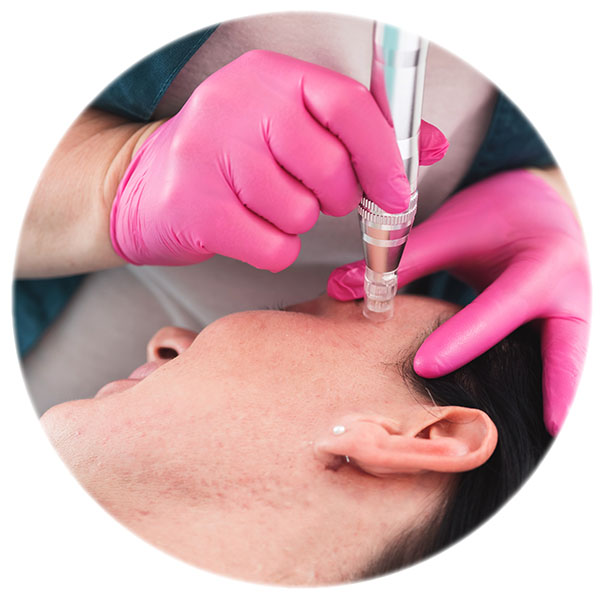 Microneedling elimina cicatricile