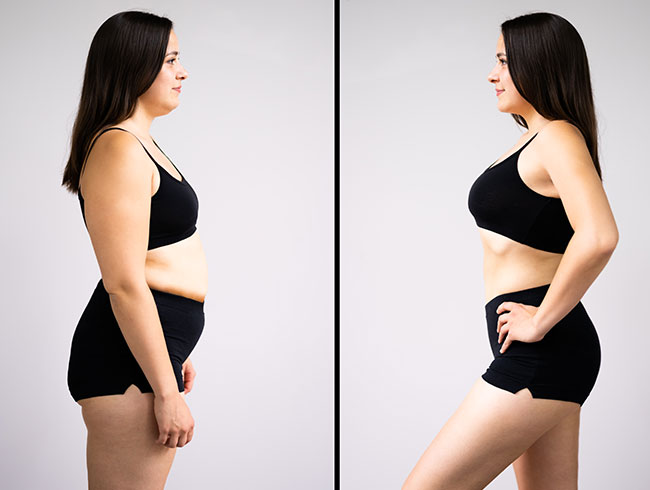 slabire si tonifiere cu EMSlim 