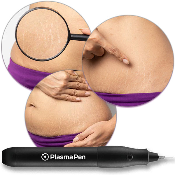 cum sa scapi de celulita