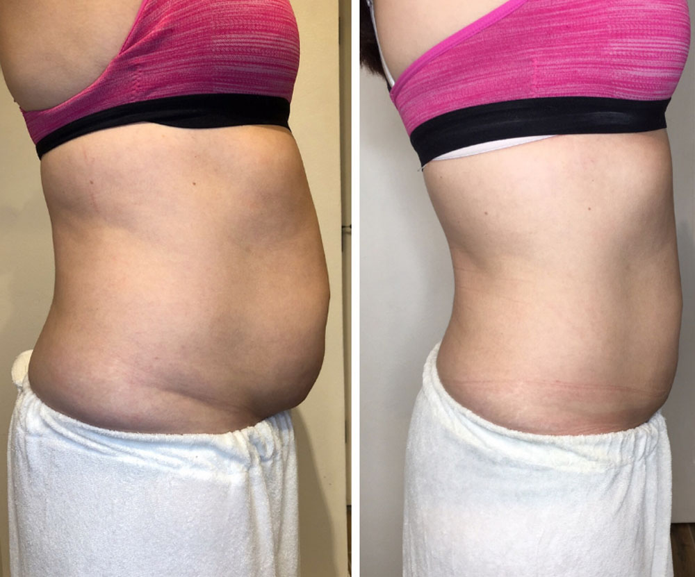 remodelare corporala