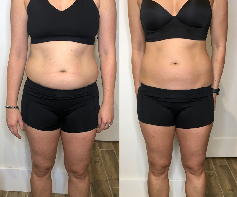 combate celulita cu ultrasunete