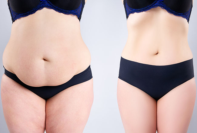 remodelare corporala