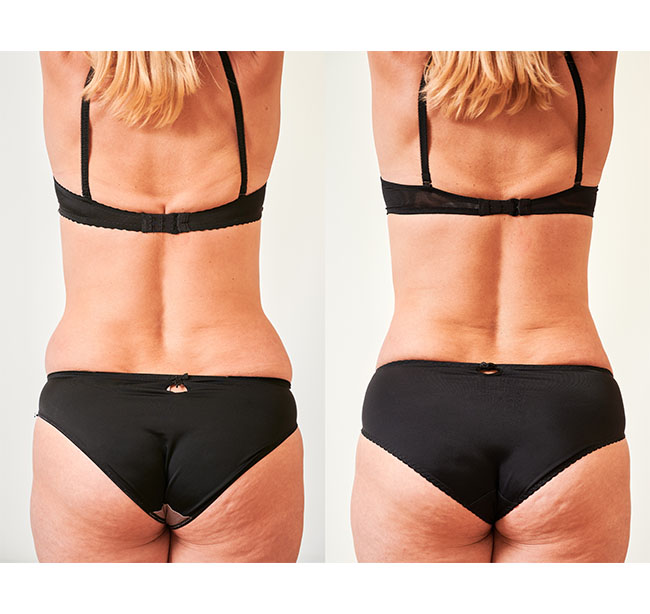 remodelare corporala