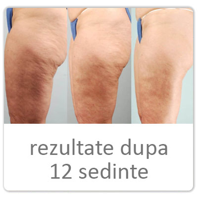 tehnici de slabit rapid