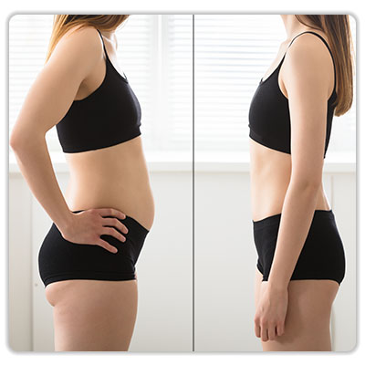 remodelare corporala