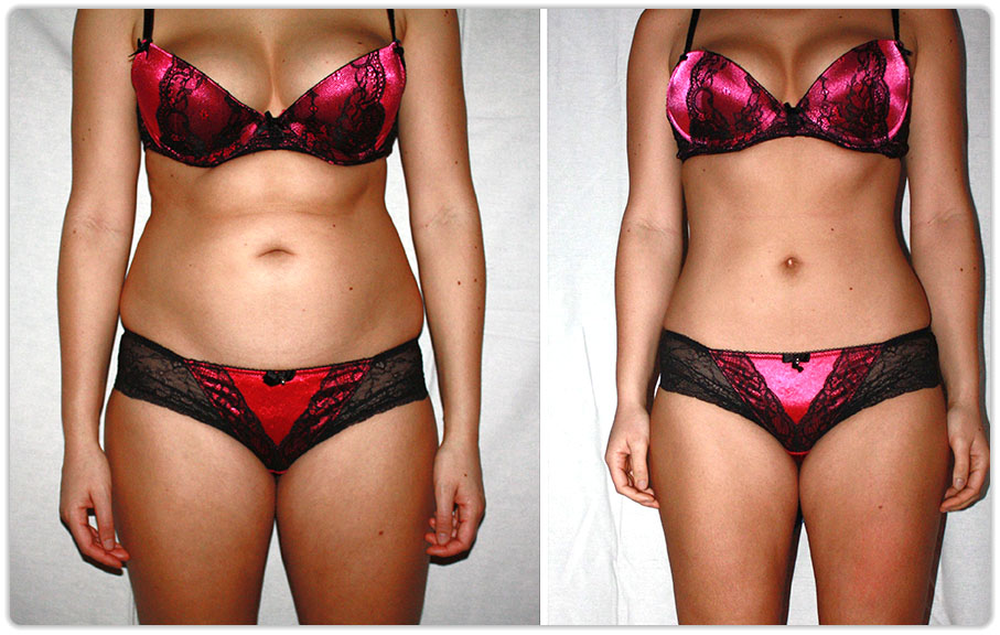 remodelare corporala