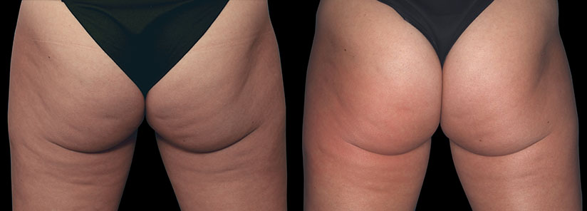 slabire si tonifiere cu EMSlim Neo