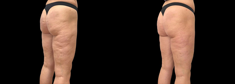 slabire si tonifiere cu EMSlim Neo