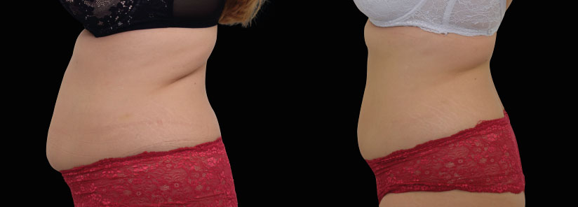 slabire si tonifiere cu EMSlim Neo