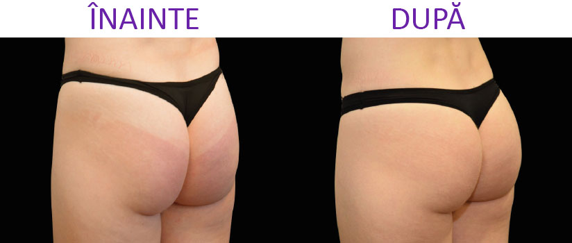 slabire si tonifiere cu EMSlim Neo