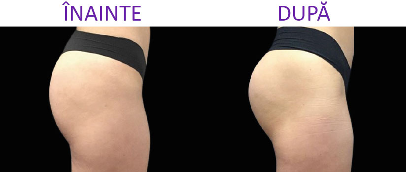 slabire si tonifiere cu EMSlim Neo