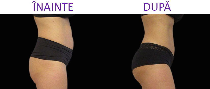 slabire si tonifiere cu EMSlim Neo