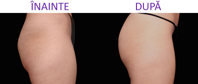 slabire si tonifiere cu EMSlim Neo