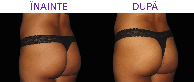 slabire si tonifiere cu EMSlim Neo