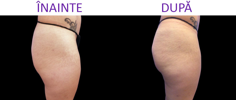 slabire si tonifiere cu EMSlim Neo