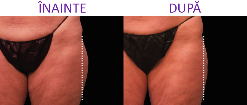 slabire si tonifiere cu EMSlim Neo