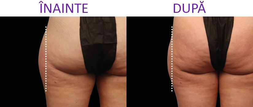 slabire si tonifiere cu EMSlim Neo