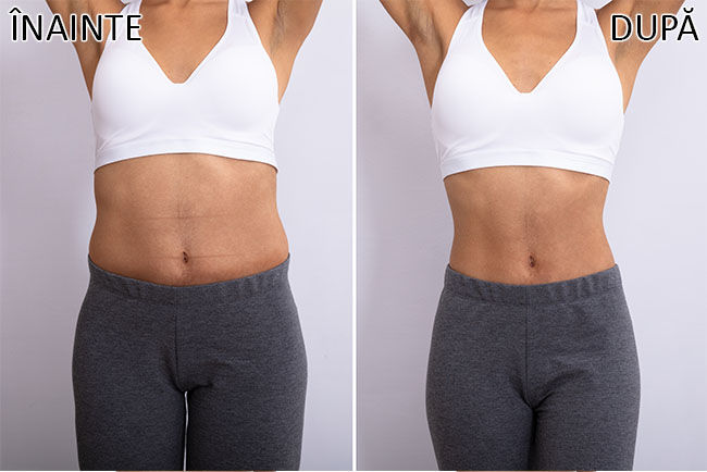 slabire si tonifiere cu EMSlim 