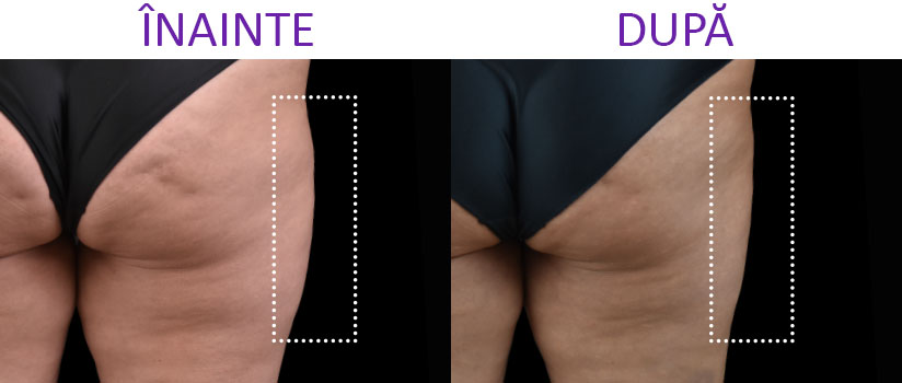 slabire si tonifiere cu EMSlim Neo