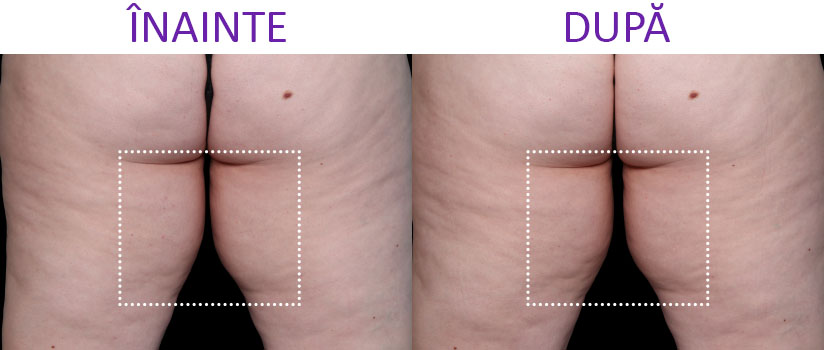 slabire si tonifiere cu EMSlim Neo