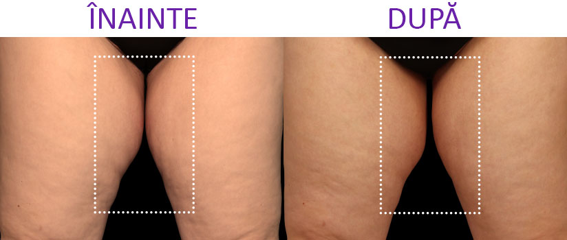 slabire si tonifiere cu EMSlim Neo