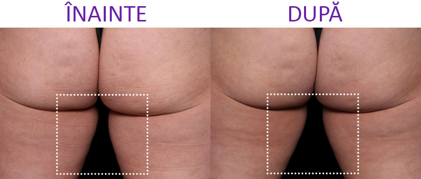 slabire si tonifiere cu EMSlim Neo