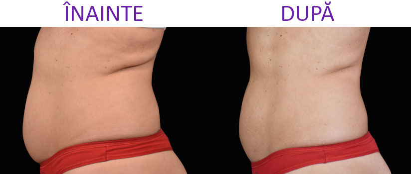 slabire si tonifiere cu EMSlim Neo