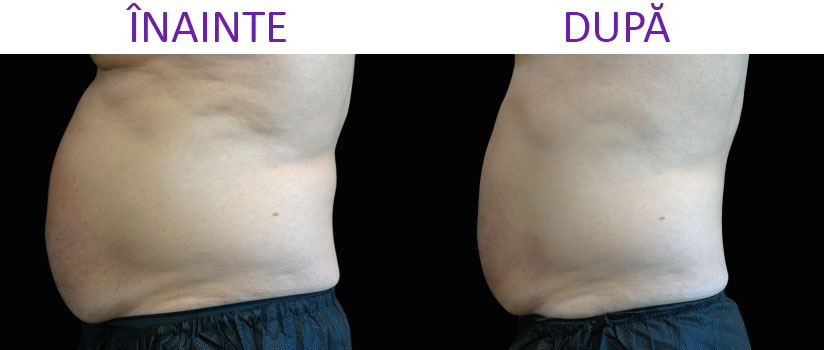 slabire si tonifiere cu EMSlim Neo