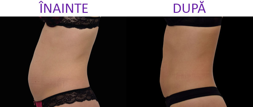 slabire si tonifiere cu EMSlim Neo