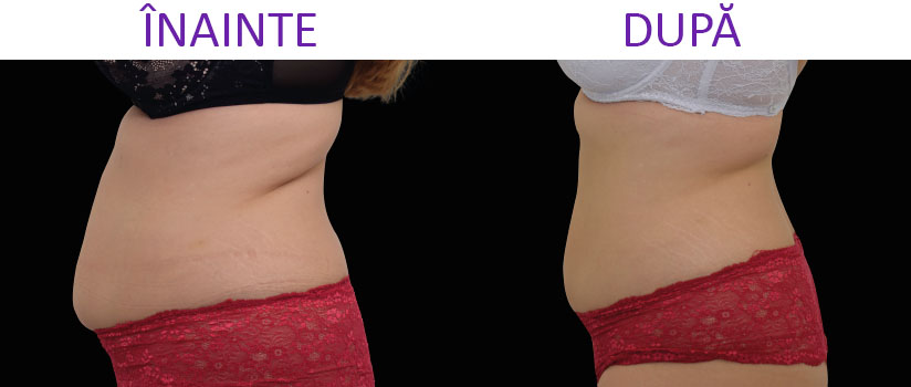 slabire si tonifiere cu EMSlim Neo