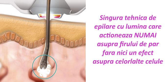 epilare cu laser