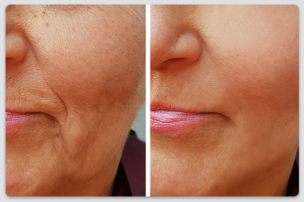 eliminare riduri de expresie