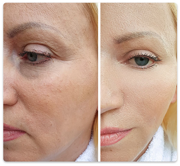 eliminare riduri fata